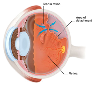 Retinal Tears Treatment | Columbia MD | Frederick MD | Towson MD | Baltimore MD