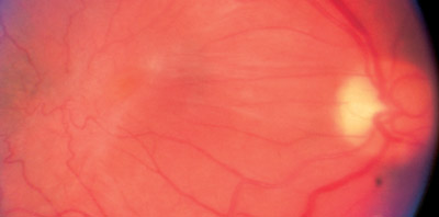 Retinal Surgery | Epiretinal Membrane Treatment | Columbia MD | Frederick MD | Towson MD | Baltimore MD